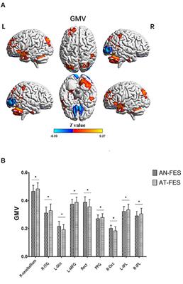 Changes in Brain Structure, Function, and Network Properties in Patients With First-Episode Schizophrenia Treated With Antipsychotics